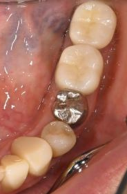 60代女性 虫歯の抜歯と同時にインプラント手術を行い治療期間を短縮した症例
