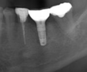 60代女性 「噛むと痛い」根っこが折れた奥歯を抜くと同時にインプラントを埋入する「抜歯即時インプラント」で短期間で治療できた症例
