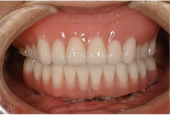 【症例】下顎オールオン４　50代女性 インプラントを利用したブリッジと自費の入れ歯で噛み合わせを回復した症例