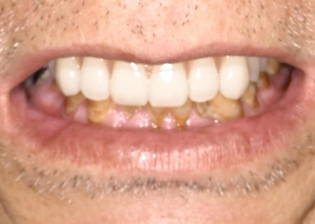【症例】60代男性 歯がない上あごにインプラントを使用した「オールオン4＋2」を装着してしっかり噛めるようにした症例
