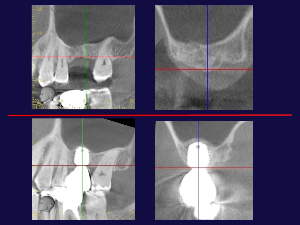 【症例】低侵襲、短期間で終わる上顎洞底挙上術で大規模な骨造成を回避した症例